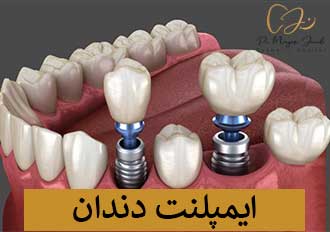 ایمپلنت دندان