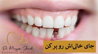 کاشت ایمپلنت