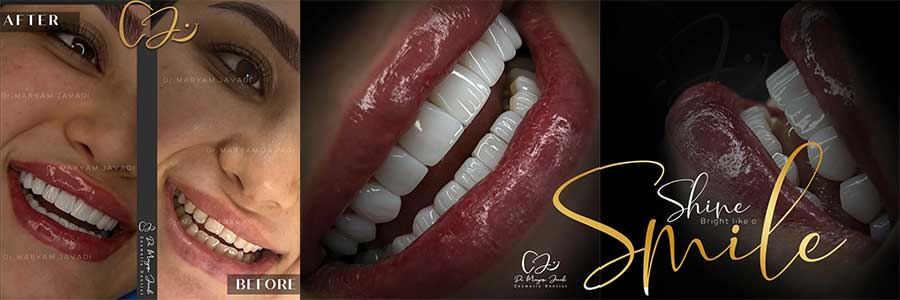 کار یک دکتر خوب کامپوزیت دندان در تهران چیست؟