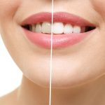 انواع روش های بلیچینگ دندان