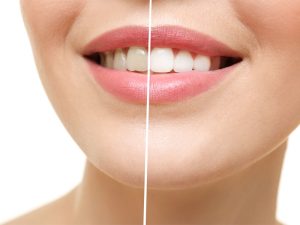 انواع روش های بلیچینگ دندان