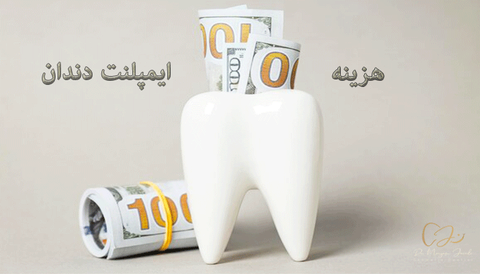 قیمت ایمپلنت دندان
