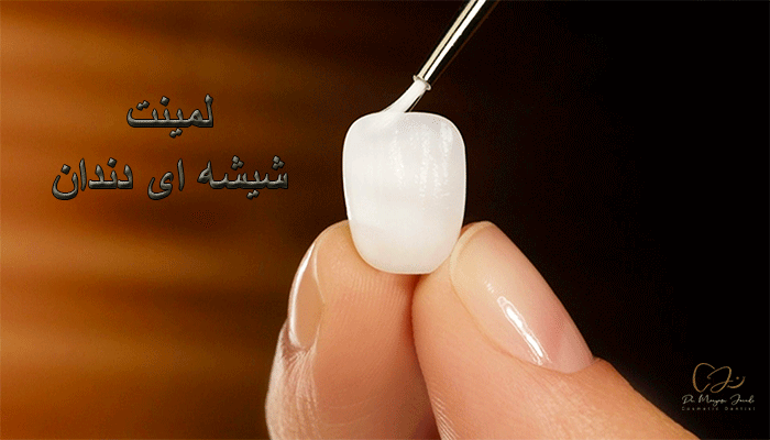 لمینت شیشه ای دندان چیست؟